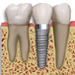 Dental Implants, City Dental, Bangor