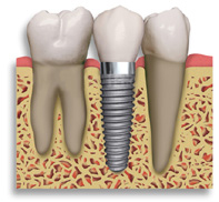 Illustration of a Dental Implant