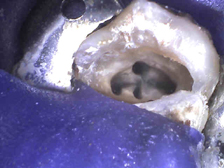 Microscope view of root canal openings