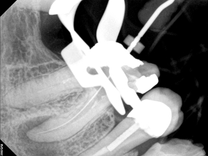 Broken Instrument Removal, Before and After Treatment