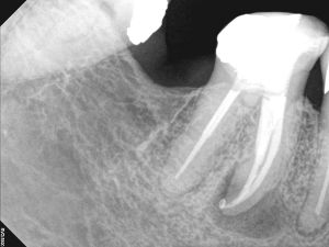 Broken Instrument Removal, Before and After Treatment