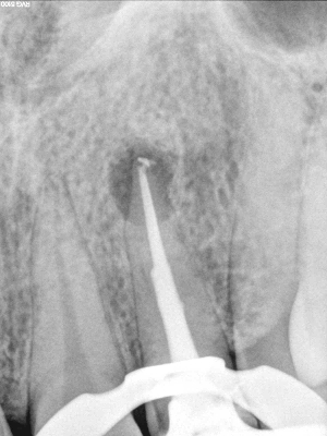 Broken Post Removal, Before and After Treatment