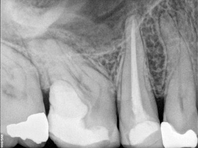 Severe Curved Canals, Before and After Treatment