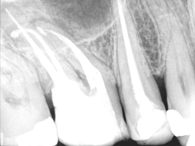 Severe Curved Canals, Before and After Treatment