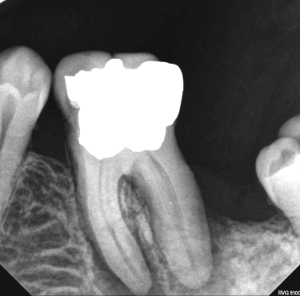 Infected molar, Before and After Treatment
