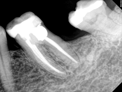 Infected molar, Before and After Treatment