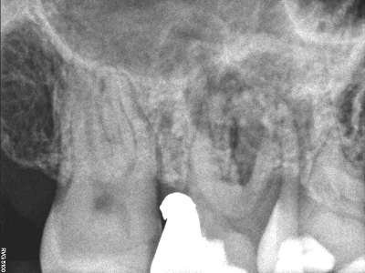 Infected Tooth, Before and After Treatment