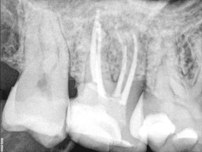 Infected Tooth, Before and After Treatment