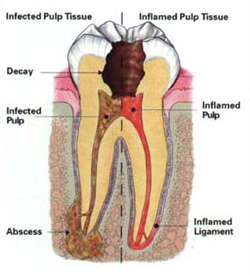 Why would I need Endodontic Treatment?