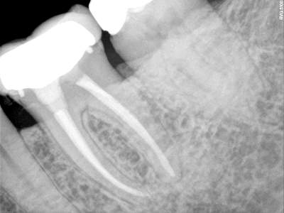 Sclerosis Canals, Before and After Treatment