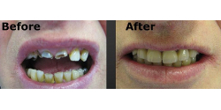 Crown and veneers, Cosmetic Dentistry