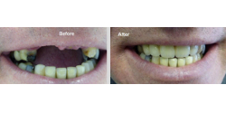 Replacement of Teeth Cost, North Wales